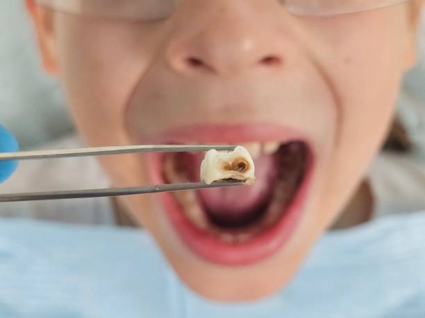 Best Emergency Broken Tooth Repair in Fairfax, VA